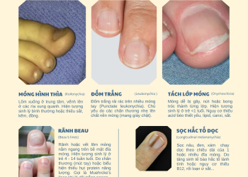 NHỮNG BIỂU HIỆN MÓNG TAY THƯỜNG GẶP Ở TRẺ EM
